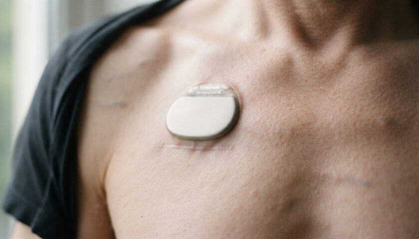découvrez le fonctionnement du moniteur reveal, sa pose sous la peau et son rôle dans la surveillance prolongée du rythme cardiaque en cardiologie.